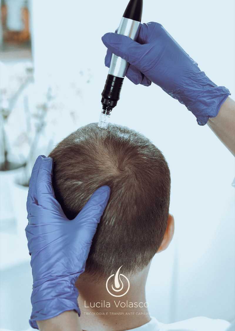 Intradermoterapia Capilar