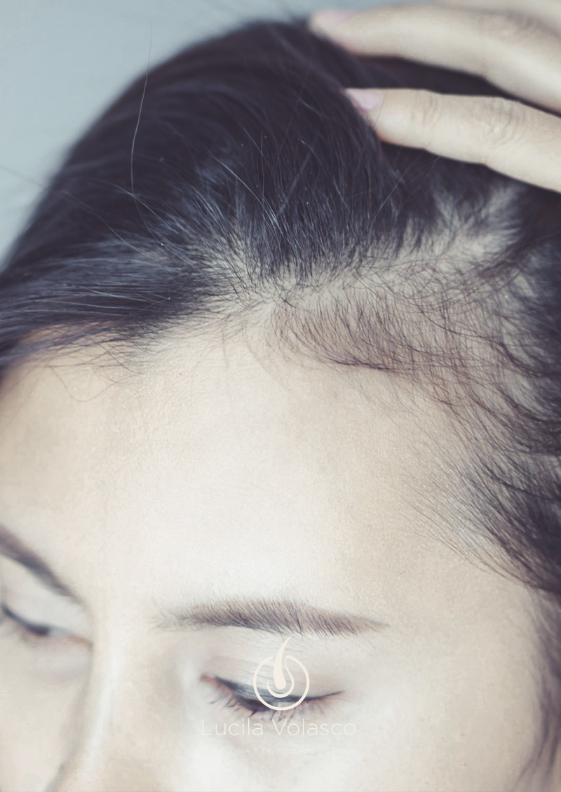 Calvície feminina: tratamentos e prevenção
